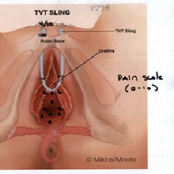 TVT - Figure 2