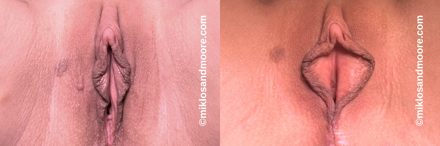 Advanced Vaginoplasty Before & After Photos | Drs. Miklos & Moore Vaginoplasty before and after photos by Drs. Miklos and Moore illustrating correction of vaginal looseness with advanced tightening techniques.