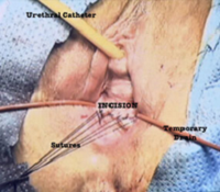 Colpocleisis – single vaginal incision surgery