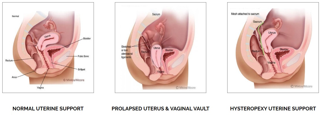 Uterine prolapse