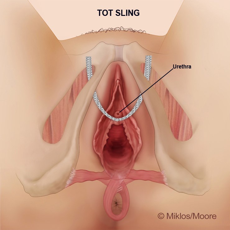 TOT sling position