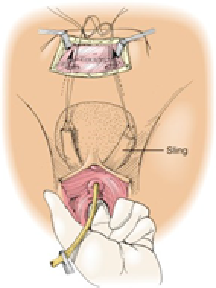  Fascia Lata Sling