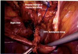 Prolene Suture & TVT sling - Right Side