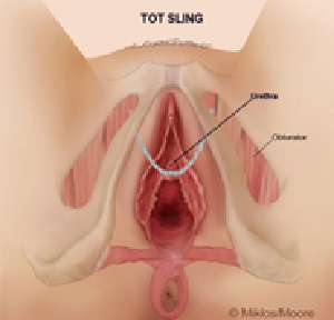 TOT Transobturator Sling