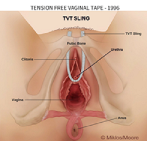 TVT Retropubic Sling