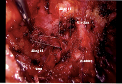 TVT retropubic sling x 2 – Left Side