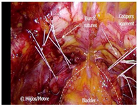 Burch Suture