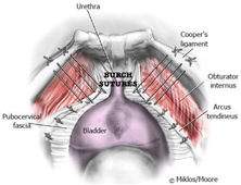 Burch Sutures