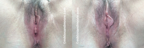 Before and after vaginal tightening surgery demonstrating restoration of the vaginal canal and improved pelvic floor support. Individual results vary. 