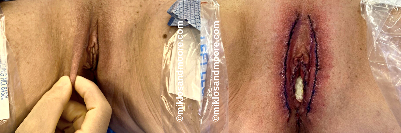Labia Majora Reshaping Results | Drs. Miklos & Moore Labia majora reduction before and after photos by Drs. Miklos and Moore restoring natural proportion to enlarged outer labia.