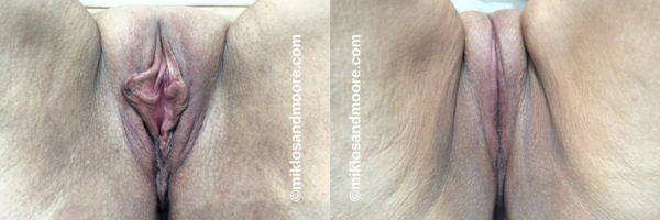 Real patient vaginal tightening before and after photos showing improved vaginal support and a more functional vaginal opening. Individual results vary.