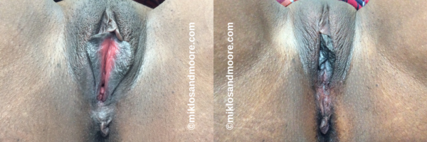 Vaginal tightening before and after photos showing improved vaginal support and treatment of vaginal laxity after childbirth. Individual results vary.