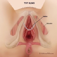 TOT sling – Normal Placement 