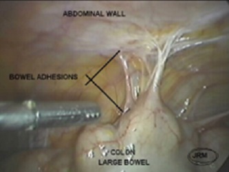 adhesion sample