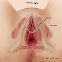  TOT sling – normal mesh placement 