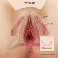 TOT sling removal for vaginal pain
