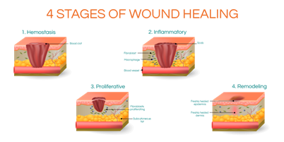 4 stages of wound healing