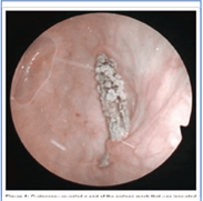 mesh erosion in the bladder