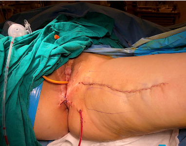 Gracilis Neovagina - surgical scar