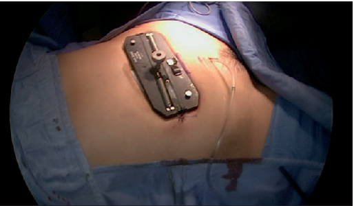 Vecchietti Neovagina- tension plate on abdomen after the surgery 2-3 weeks