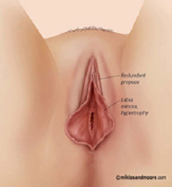 wide clitoral hood