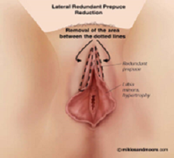 Reducing Prepuce Width