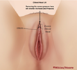 Reducing Prepuce Length