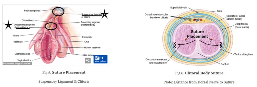 Clitoral Body Suture 