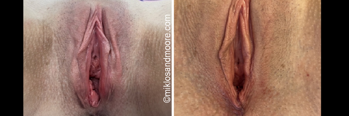 Restorative Perineoplasty Before & After Photos | Drs. Miklos & Moore Perineoplasty before and after photos by Drs. Miklos and Moore illustrating restoration of perineal anatomy and vaginal support.