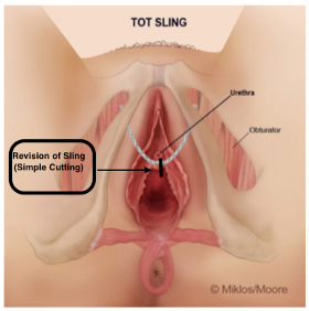 TOT cutting for urine retention