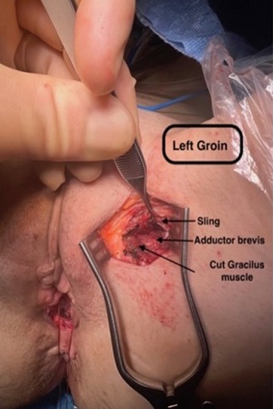 TOT in left groin