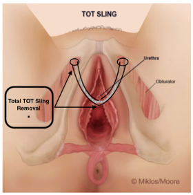 Total TOT removal