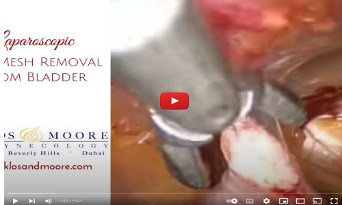 Laparoscopic TVT Mesh Removal From Bladder