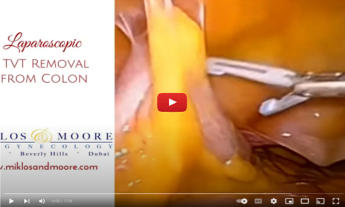 laparscopic tvt removal from colon