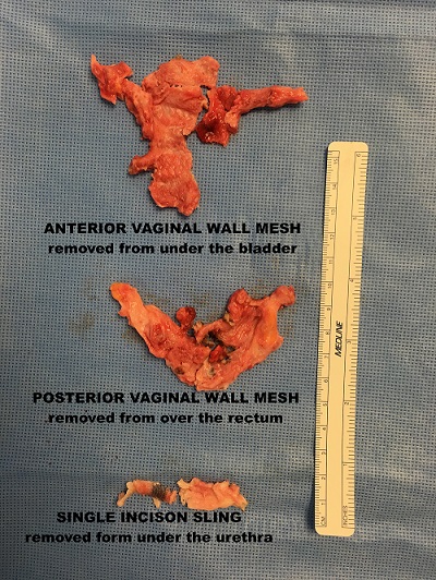 Figure 2: Dr Miklos removed all 3 pieces of mesh in a patient with chronic pain 