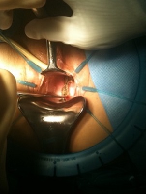 FIGURE 2: Sacralcolpopexy mesh extrusion and pain. Patient to have this area of the sacralcolpopexy removed.