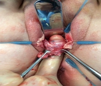 TIGHT SLING AT TIME OF DISSECTION