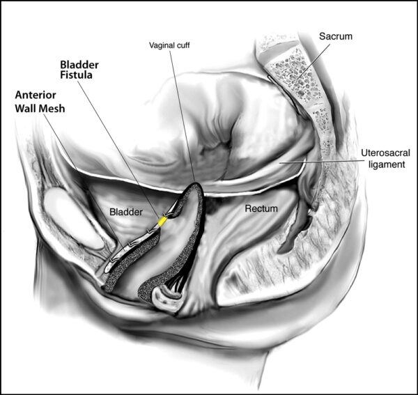 Anterior Mesh -Fistula