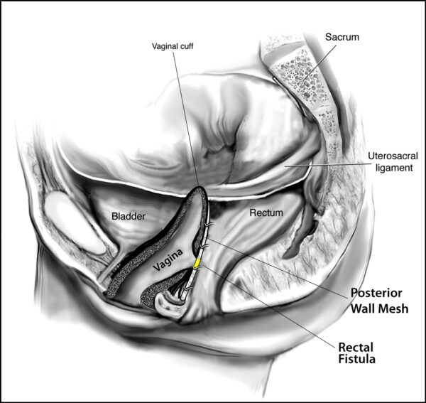 Posterior Mesh – Fistula