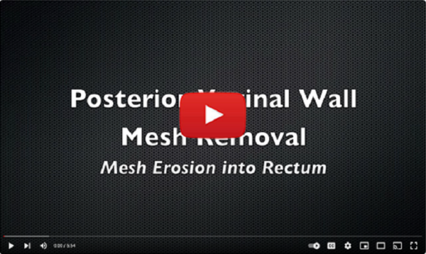 posterior vaginal wall mesh removal