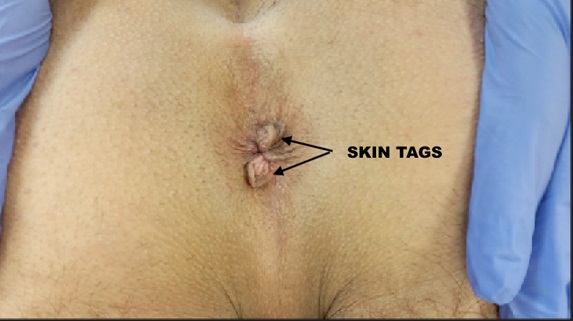 anal skin tag