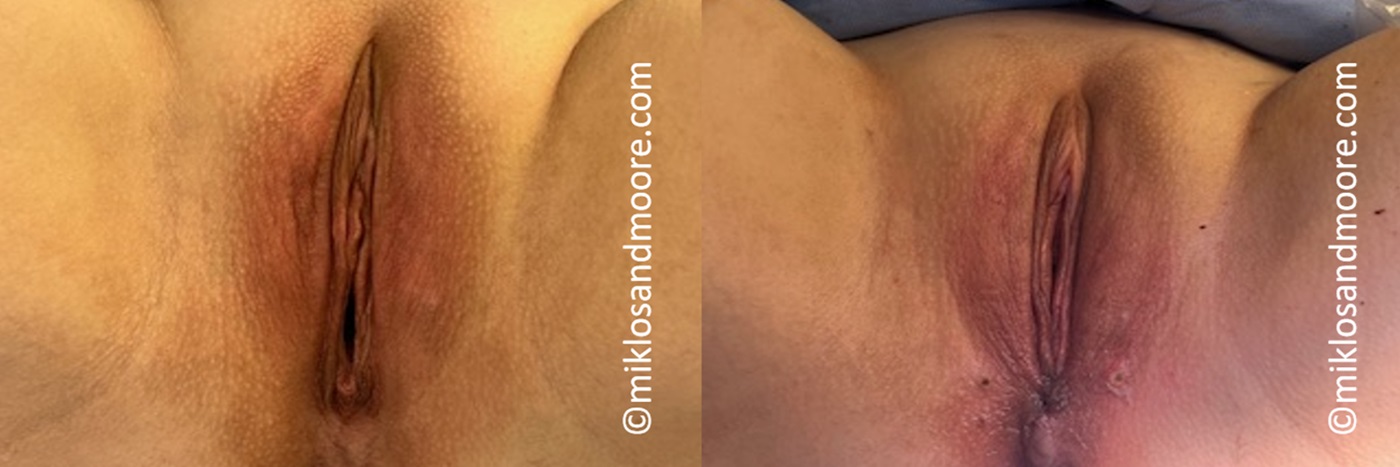 Cosmetic Perineoplasty Before & After Photos | Drs. Miklos & Moore Perineoplasty before and after photos by Drs. Miklos and Moore demonstrating cosmetic and reconstructive vaginal surgery results.