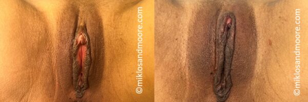 Clitoropexy before and after photos showing reduction of excess clitoral hood tissue and improved vulvar symmetry. Individual results vary.