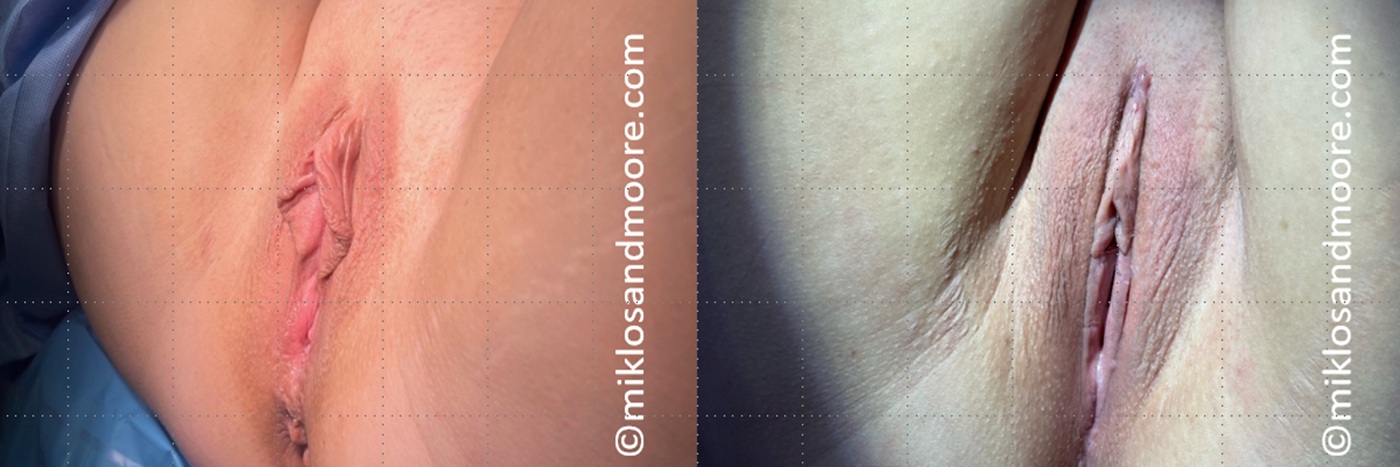 labiaplasty-105 labiaplasty-105