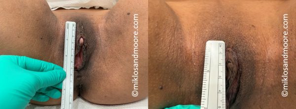Real patient clitoropexy before and after photos showing clitoral hood reduction and improved vulvar balance. Individual results vary.