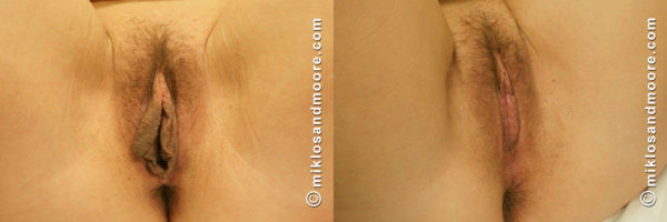 Perineoplasty Before & After Photos | Drs. Miklos & Moore Perineoplasty before and after photos by Drs. Miklos and Moore showcasing restoration of the vaginal opening after childbirth.