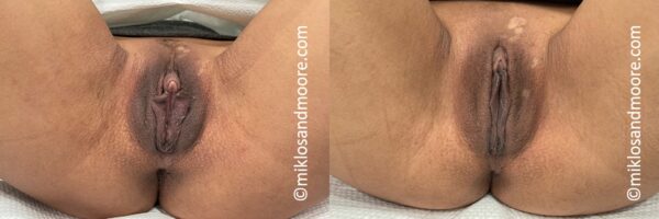 Before and after labiaplasty demonstrating reshaping of the labia minora for a more balanced, natural appearance. Individual results vary.