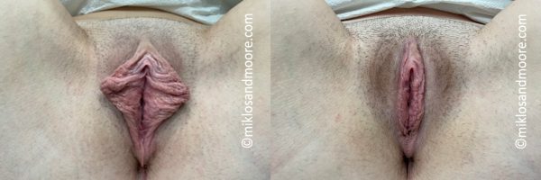 Real patient labiaplasty before and after photos showing reduction of excess labial tissue and improved contour. Individual results vary.