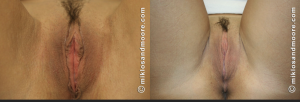 Botched labiaplasty revision before and after showing healed surgical results