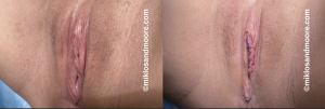 Botched labiaplasty revision before and immediately after corrective surgery